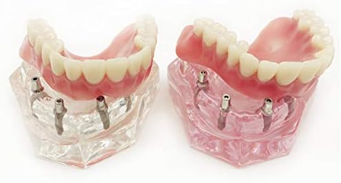 Модел на зъбен имплант, K99 Модел на зъбен имплант Overdenture Горните зъби 4 Импланта Демонстрационен Модел
